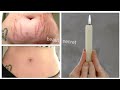 With 1 candle, get rid of stretch marks completely in just 7 days