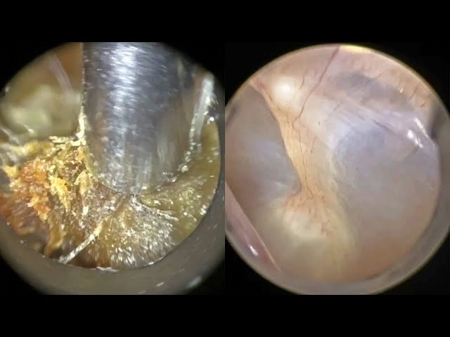 138 - Exceptionally Stubborn, Dry & Adhered Keratinous Dead Skin Extracted from Ear using WAXscope®️ class=