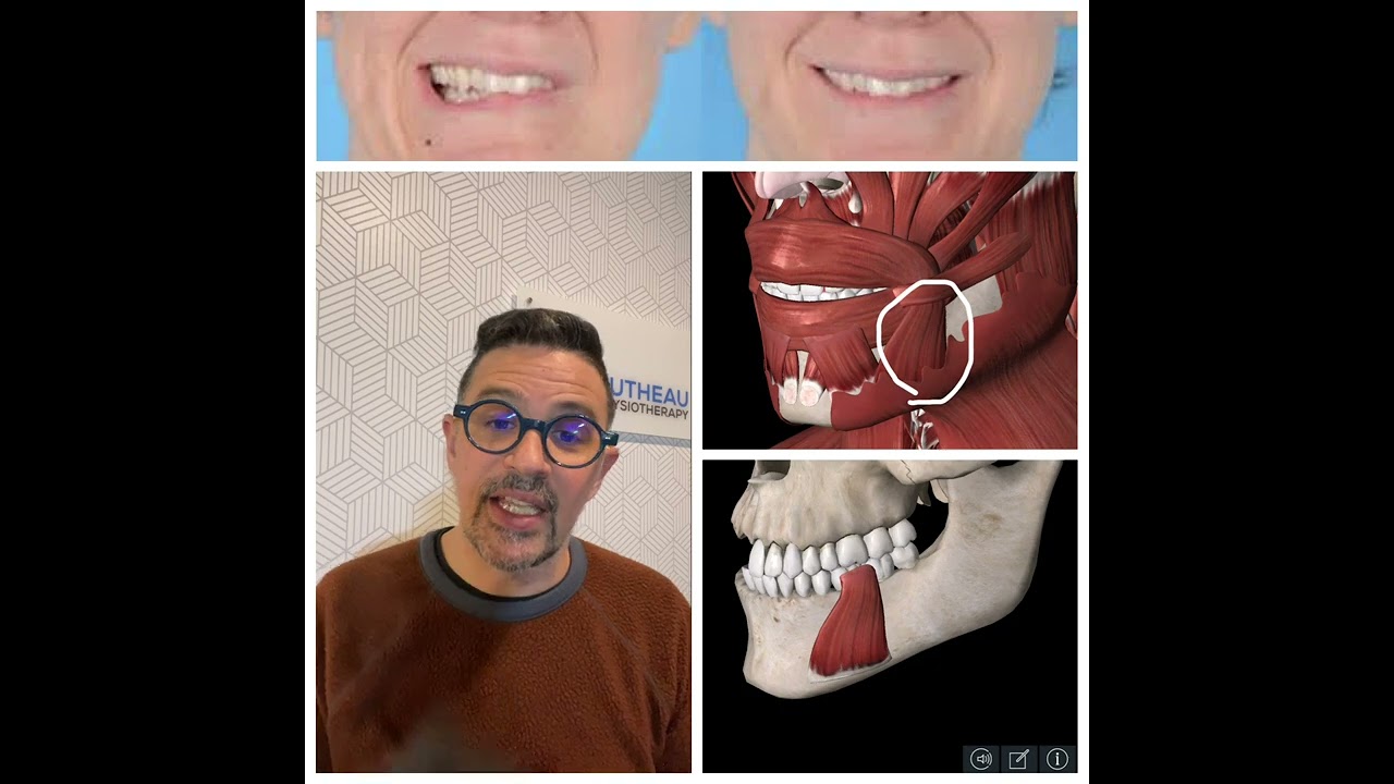 Why Your Smile Might Have Not Returned Fully After Bell's Palsy