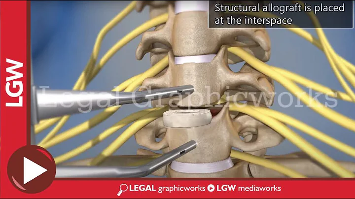 Anterior Cervical Discectomy and Fusion C6-C7 3D surgery animation