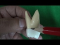 Morphology of Maxillary Permanent Second Molar