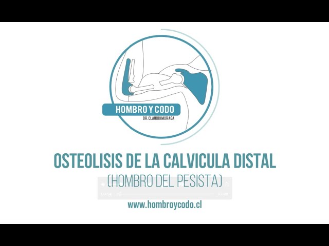 Hombro: Osteolisis clavícula distal (u hombro del pesista)
