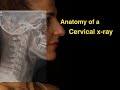 Anatomy of a Cervical x-ray