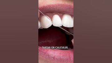 Bleeding Gums? Why You Should Keep Flossing