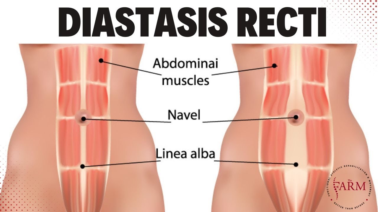 Understanding Diastasis Recti: Causes, Symptoms, and Treatment 