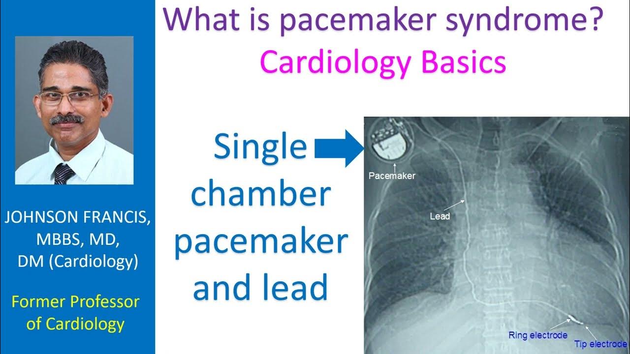 What is pacemaker syndrome? Cardiology Basics YouTube