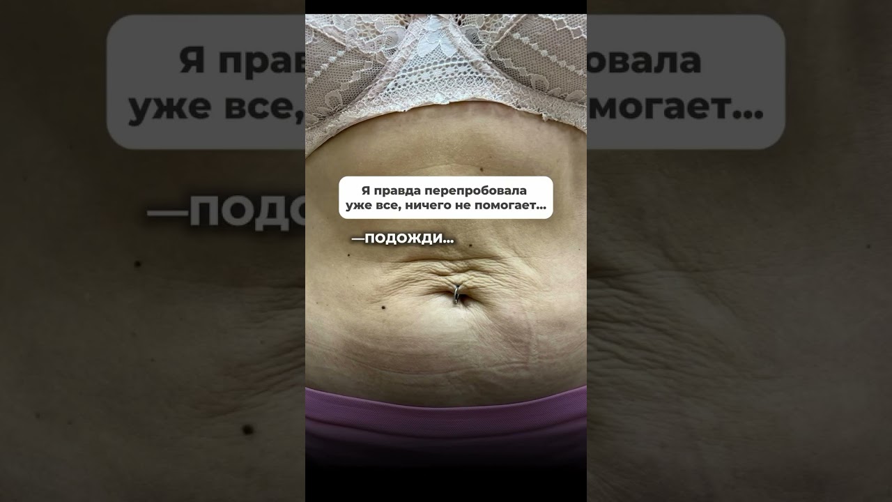 Как убрать обвисшую кожу на животе после беременности всего за 1 процедуру