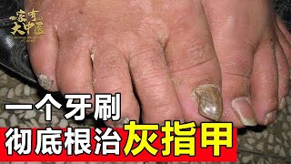 20年不愈的灰指甲他用一个牙刷就彻底根治【健康来了】