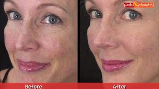 My Experience Getting Cheek Filler (Voluma) for Volume & Lift!