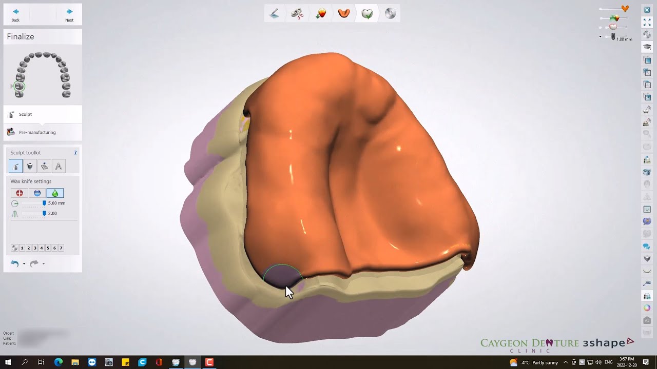Digital Custom Tray Design