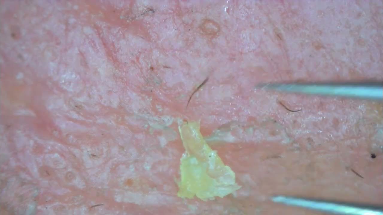 0211 keratin plug removal nose YouTube