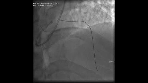 Microcatheter Tip Fracture During LAD CTO PCI: A Complication Video 5