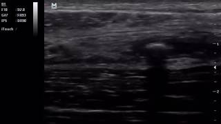 Acute Appendicitis With Fecolith