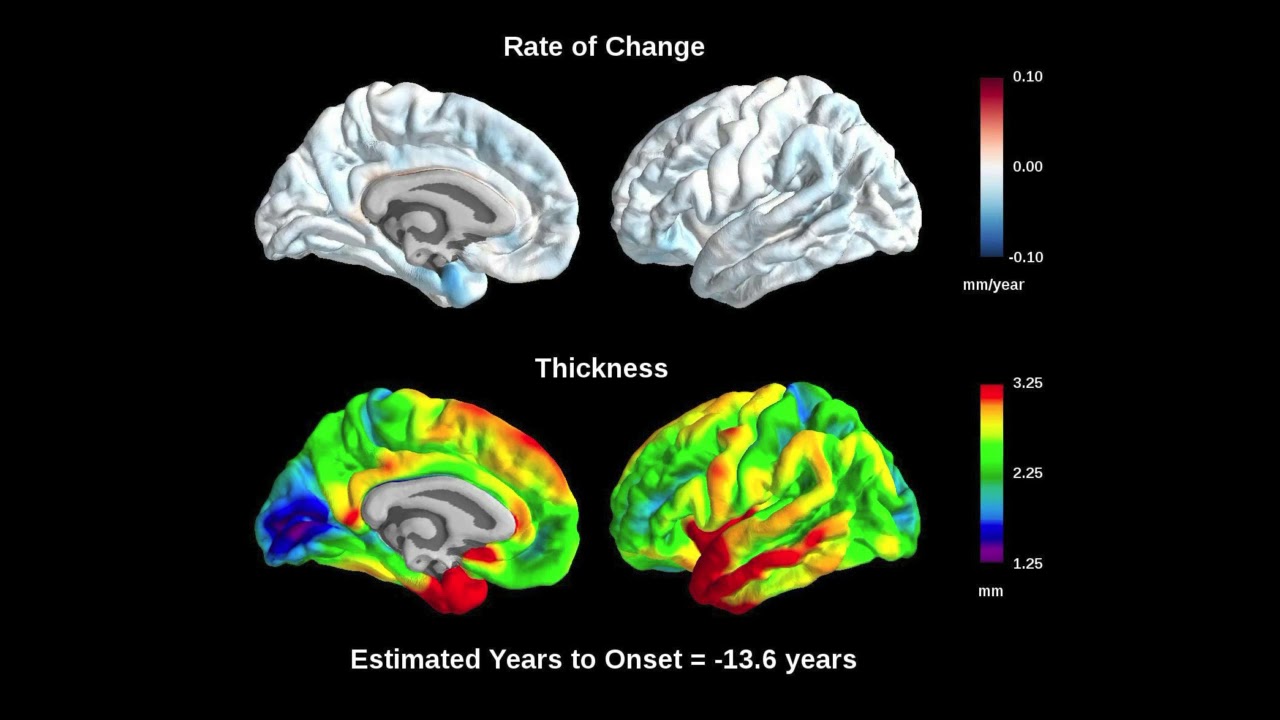 Voxel-wise change in cortical thickness by MRI in mutation carriers ...
