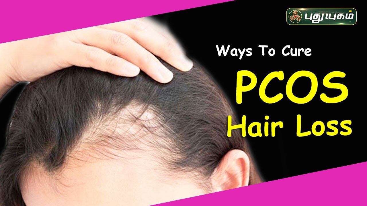 PCOS and Hair Loss - Why It Happens and How to Treat It | Dr.M.S.UshaNandhini | PuthuyugamTV
