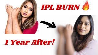 Kenzzi IPL BURN MARKS UPDATE After 1 Year | How long it takes IPL Burn Mark to Fade  | IPL vs Laser