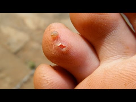 Jiggers vs  Chiggers!  What&rsquo;s the Difference?