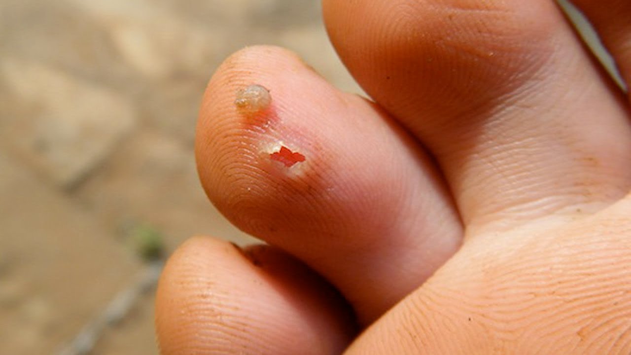 Jiggers vs Chiggers! What's the Difference? - YouTube