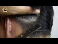 Big Flakes Scalp Scratching And Picking - Dandruff Removal | Mr Dandruff Flakes #60