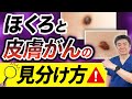 ""ほくろ""を放置すると命の危険⁉︎皮膚がんの初期症状とほくろ・メラノーマの見分け方