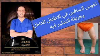 انحراف الساقين للداخل في الاطفال الاسباب والعلاج للدكتور احمد العطار