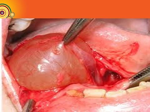 تورم الغدة اللعابية الضفيدعة الدكتور فهيد السبيعي