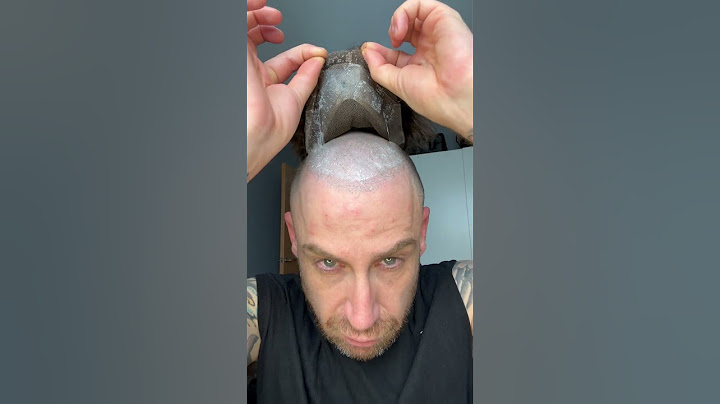 🔥STOP SCROLLING! You deserve better than that bald spot 👑#hairloss #bald #haircare #menshair