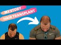 Hair transplant chicago 3500 grafts jays story