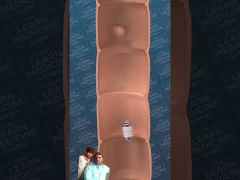 Capsule Endoscopy #science