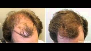 Best-Selling Hair-Regrowth Formula Before And After