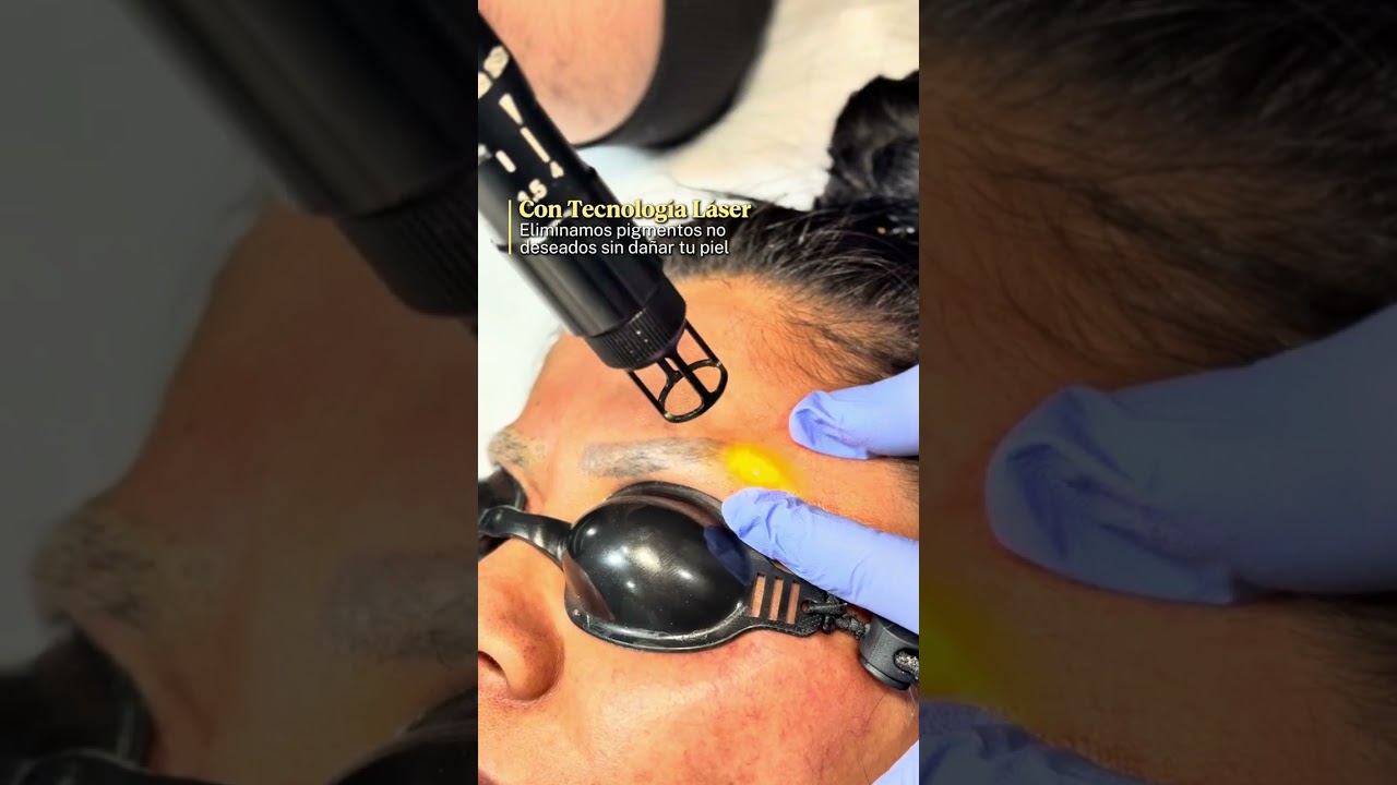 Eliminación de Tatuaje de Cejas 