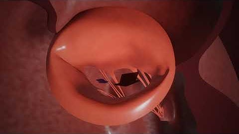 MitraClip mitral heart valve repair