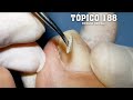 UNHA ENCRAVADA CAUSADA POR FUNGOS (INGROWN TOENAIL CAUSED BY FUNGI) - PODÓLOGO MAURÉLIO