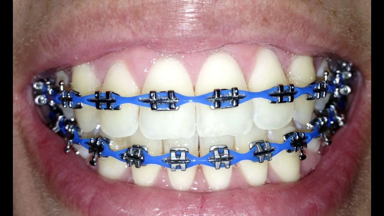Braces Update # 26 Power Chains - YouTube