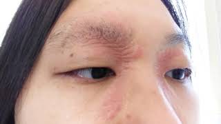 Steroid Cream Hydrocortisone Eczema Treatment