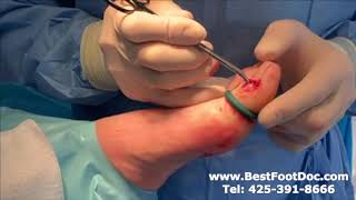 Removing a Mucinous Cyst - Dr. Timothy Young