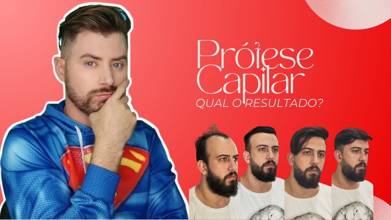 Como Fica Prótese Capilar Masculina? - Barbearia Super Barba BH