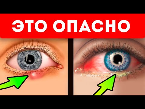 Глаза укажут! 21 неявный признак болезней по глазам и векам!