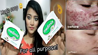 Get Clean and Clear Skin at home, Medimix soap review, اردو / हिंदी