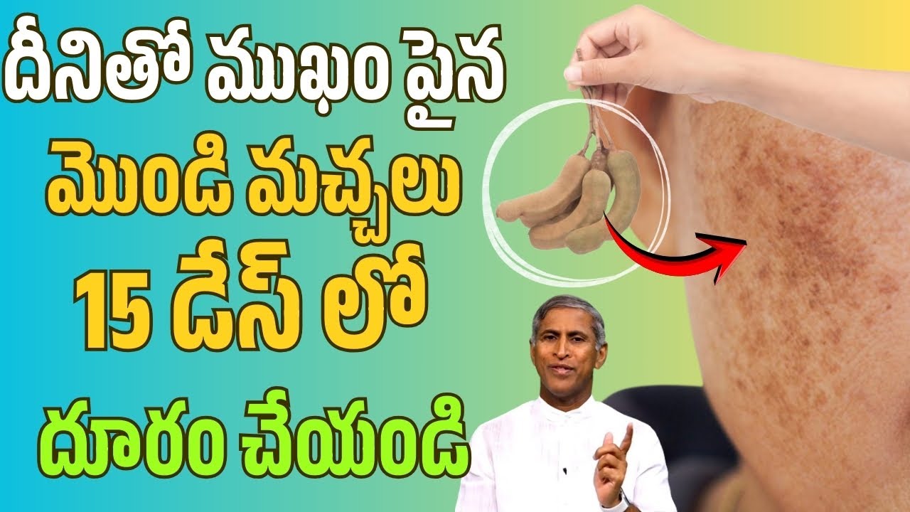 Pigmentation | దీంతో ముఖంపై మొండి మచ్చలు 15 డేస్ లో దూరం చేయండి | Dr Manthena Satyanarayana Raju