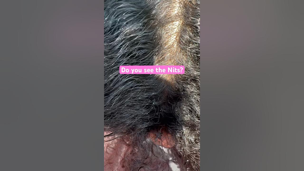Nits on Dark Hair l Long, Curly Hair 👩‍🦱 l head lice hair explore