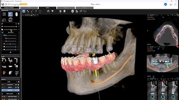 CS 3D Imaging Premium - Accelerates your implant planning workflow with AI-powered software