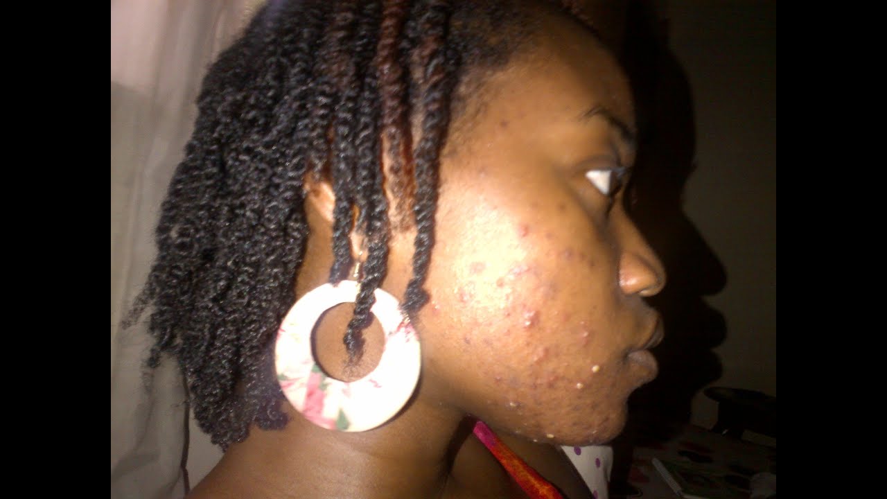 How I Got Rid of My Acne - My Story - YouTube
