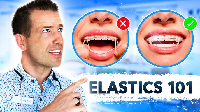 How to use Elastics - Orthodontic Appliances - Doctor Emma
