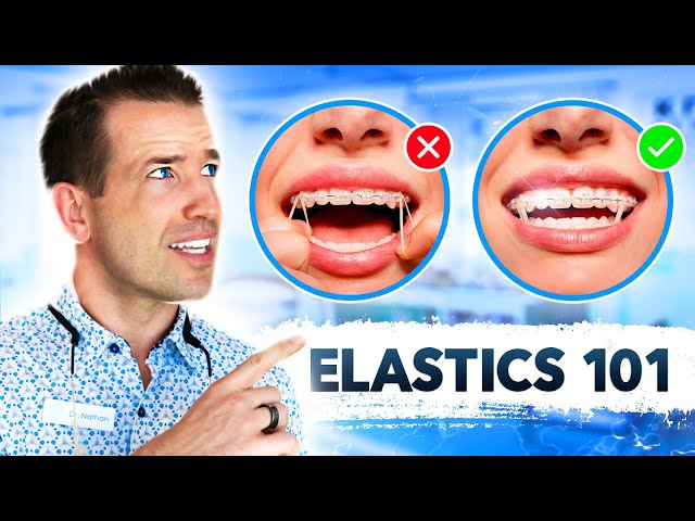 How elastics / rubber bands move teeth (time lapse) - Braces
