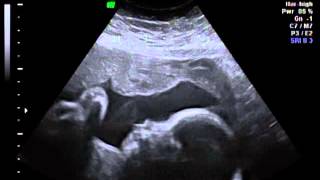 Baby Sofia 26 weeks ultrasound- Part 3