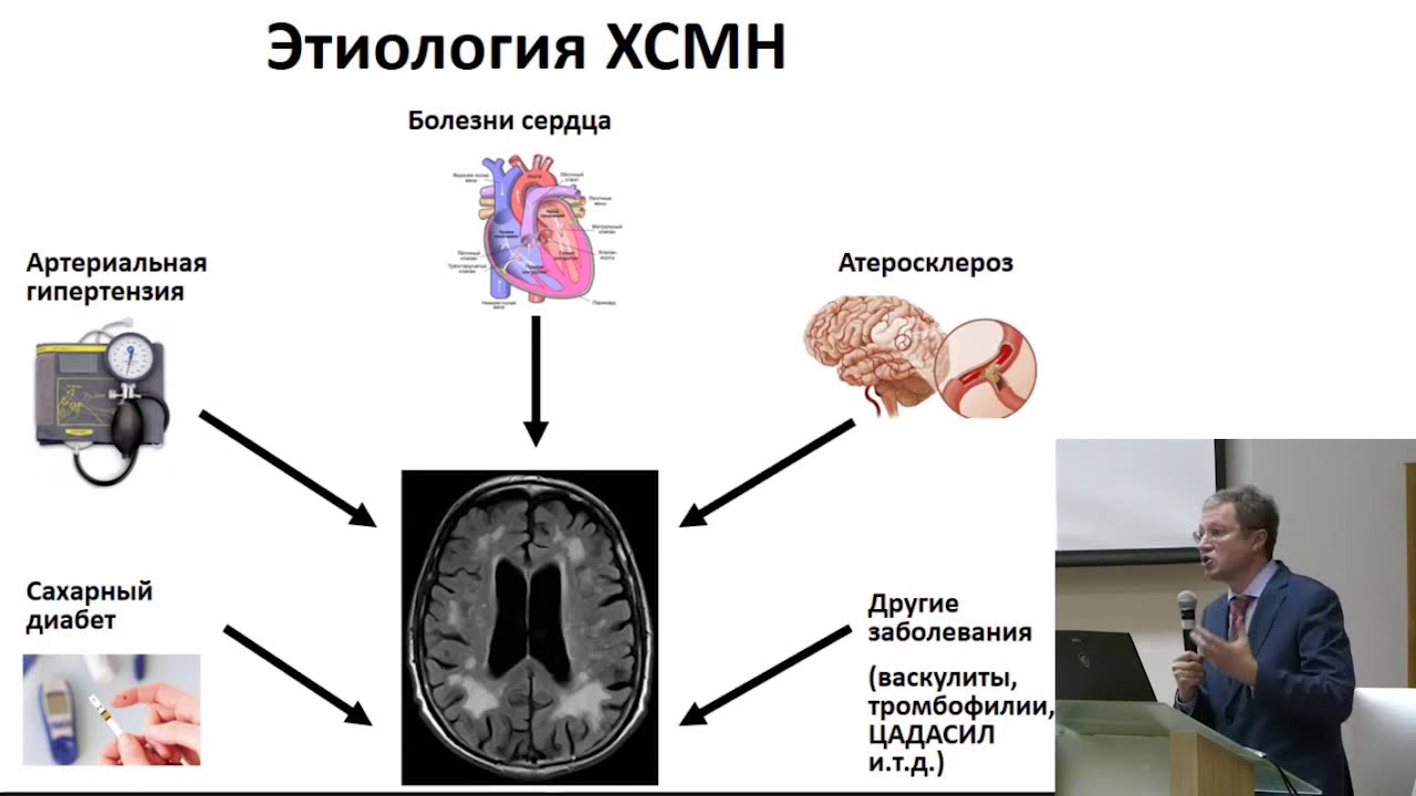 Ишемия мозга лечение препараты. Хроническая ишемия головного мозга. Степени ишемии головного мозга. Хроническая ишемия головного мозга этиология. Хроническая ишемия мозга мрт.