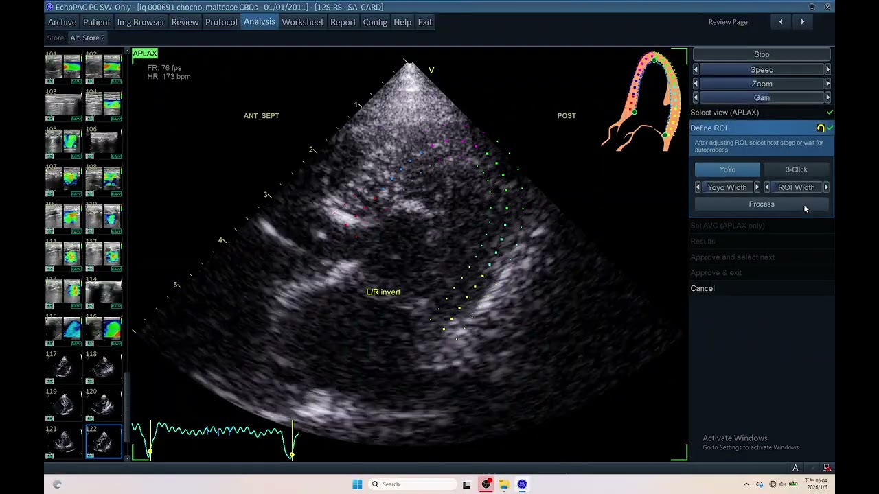 IQ 691 LVEF LV TTP LV PSD ECHOCARDOGRAPHY