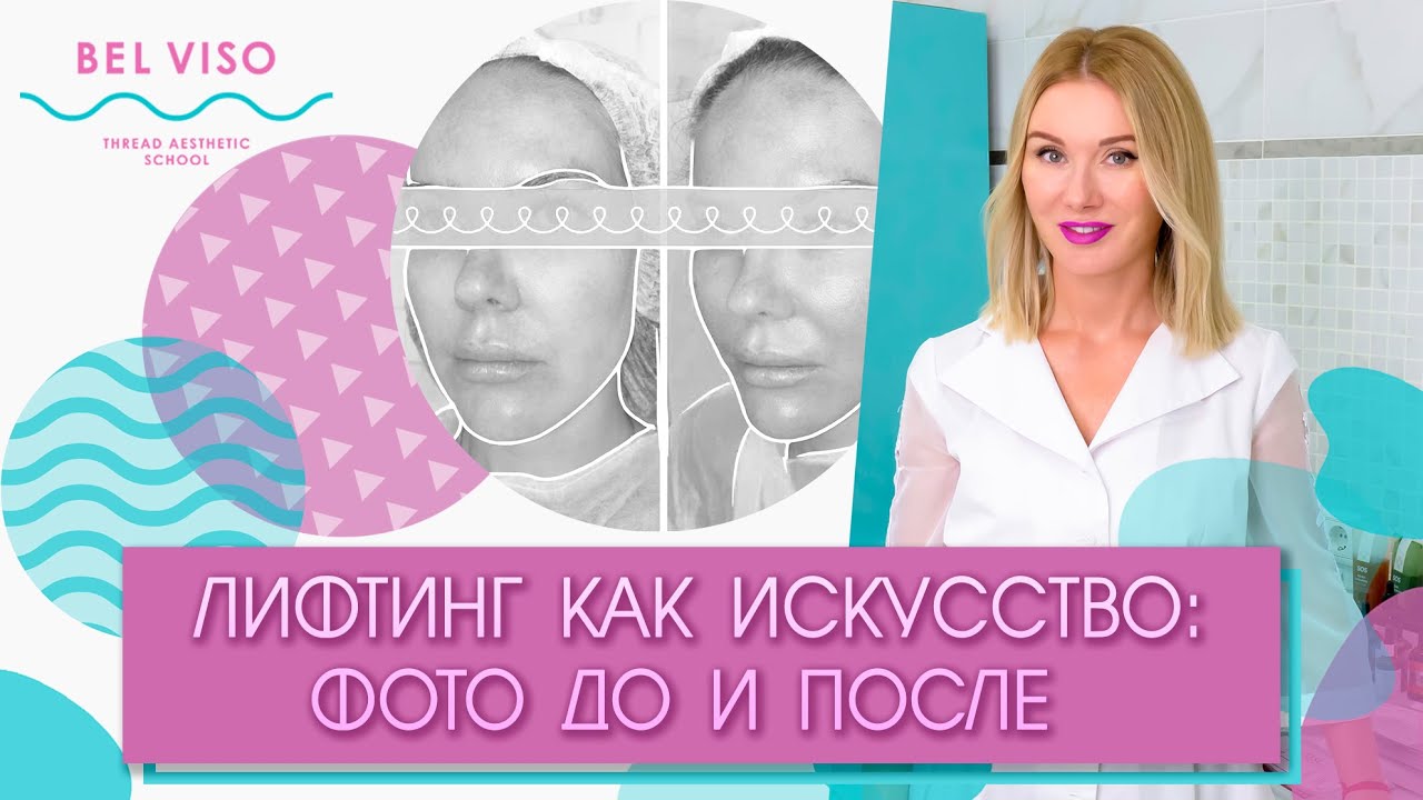 Нитевой лифтинг лица. Фото "до" и "после"