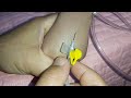 طريقه ربط كانيولا للاطفال طريقه ربط كانيولا للاطفال